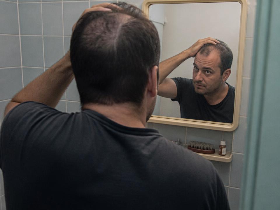 Homem observando no espelho a coroa com os fios mais ralos